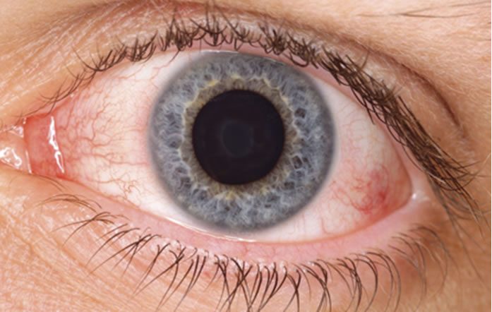 Síndrome del ojo seco